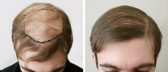 The best remedy for baldness: masks recipes and infusions, drug TOPPIK