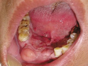 Što je eritroplast u ustima?