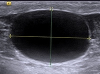 Ultrasound of scrotum