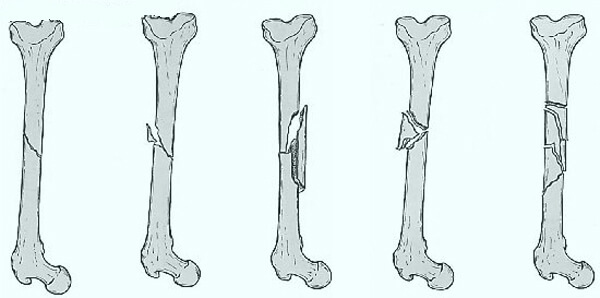 fratura-ray fechado, o osso e o deslocamento