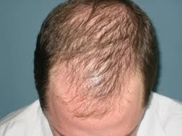 Baldness in men at different ages: how to stop