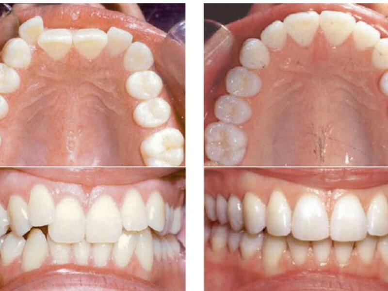 Фото зубов до и после брекетов фото