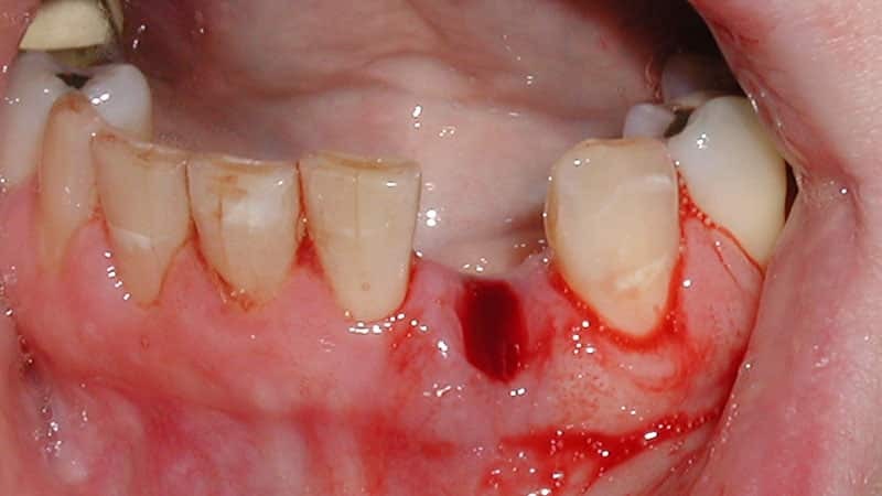 Ziehen Zähne - wie lange die heilenden Gummis