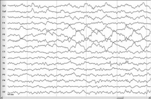 Resultaat van EEG-studie