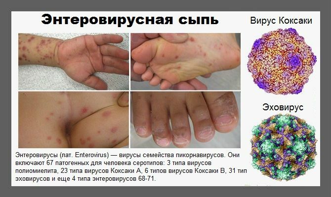 Enterovirus infection: symptoms