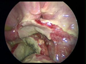 Purulente peritonitis