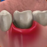 Geneeskundige behandeling van tandvleesziekte