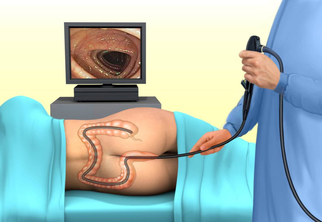 Ziekte van Crohn bij kinderen: behandeling, symptomen en diagnose