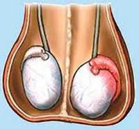 Orchitis of testicles in men