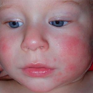 Liječenje-dermatitis-imati-djecu