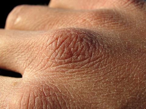 As causas de espinhas nas mãos