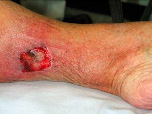 Tetanus is an infection in the wound