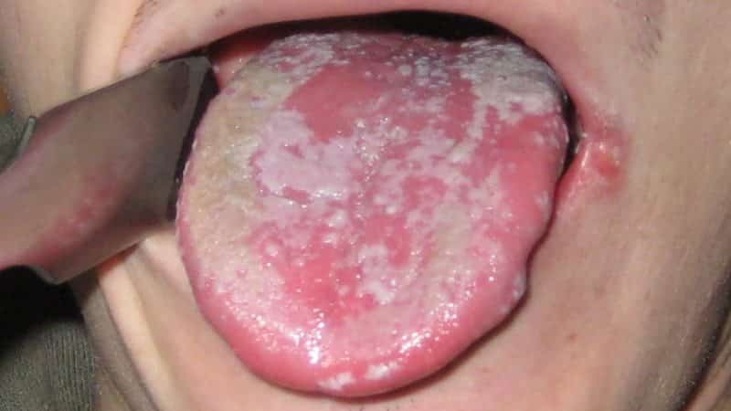 sensasi terbakar di mulut menyebabkan dan pengobatan