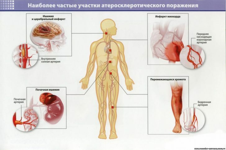 47291-varicose-enlargement-veins-pregnancy
