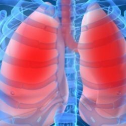 Pneumokokna upala pluća