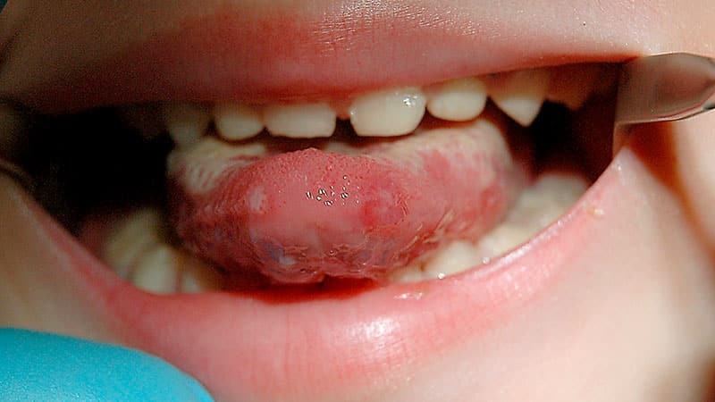 Behandlung von Candidiasis in dem Mund bei Erwachsenen