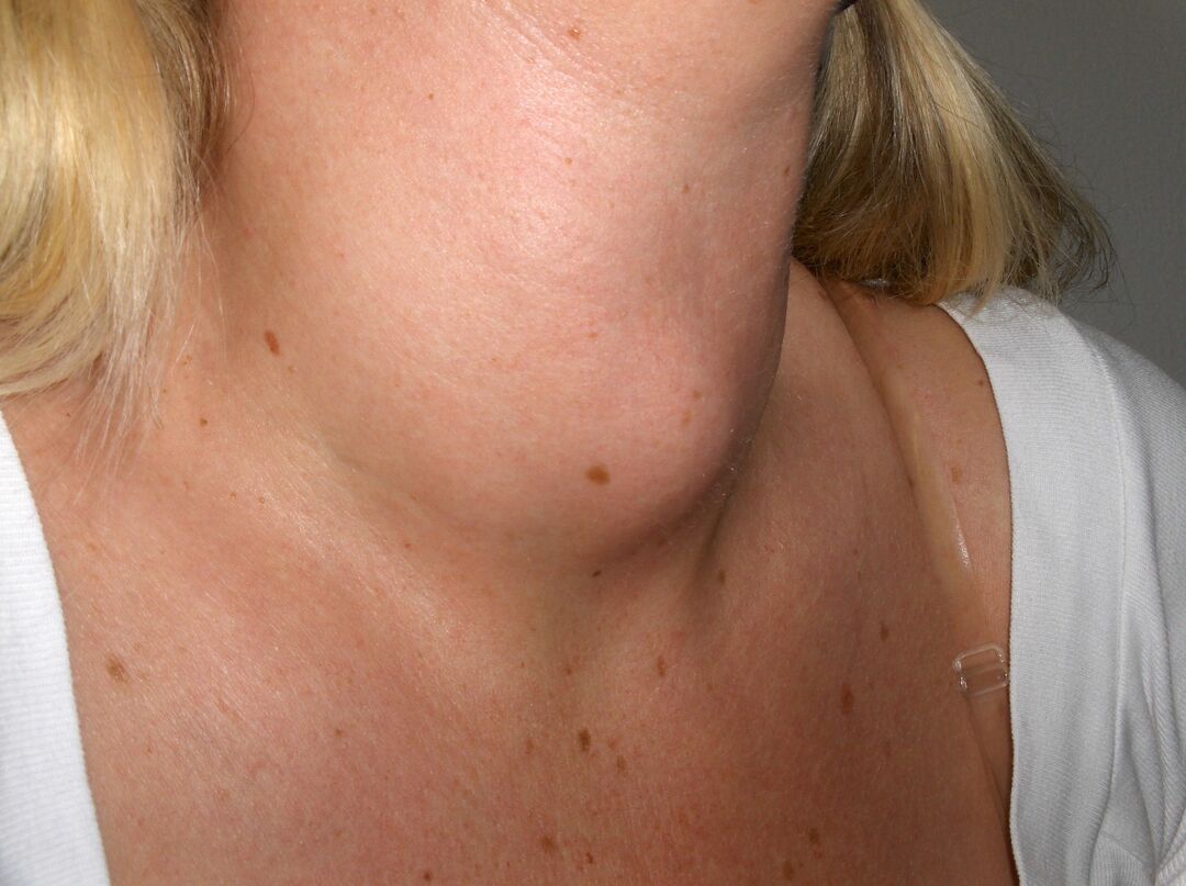 Diffuse toxic goiter: symptoms, causes, diagnosis, treatment and prevention