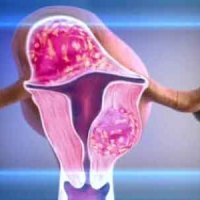 Operation to remove uterine fibroids