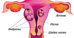 Fibroids van de baarmoeder