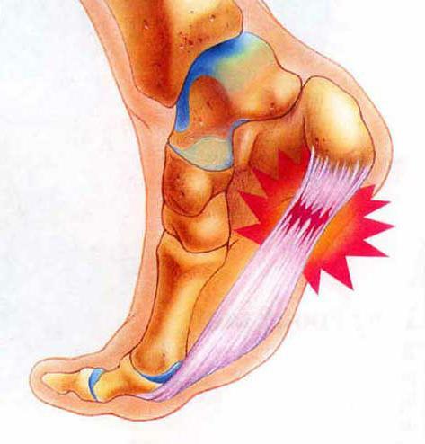 Treating the calcaneal spur at home