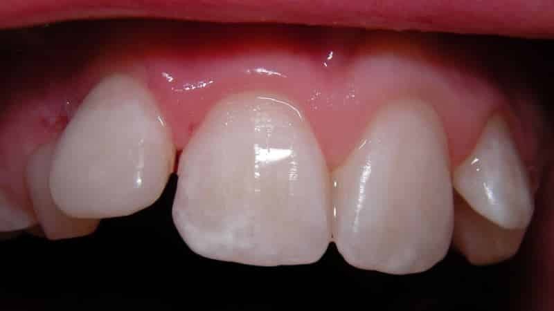 srebrzenia zębów mlecznych u dzieci
