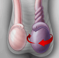 Dislocation of the testis
