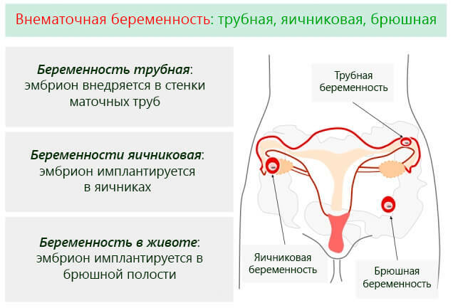 Pregnancy-extra-uterus