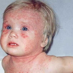 Dermatite atópica em crianças
