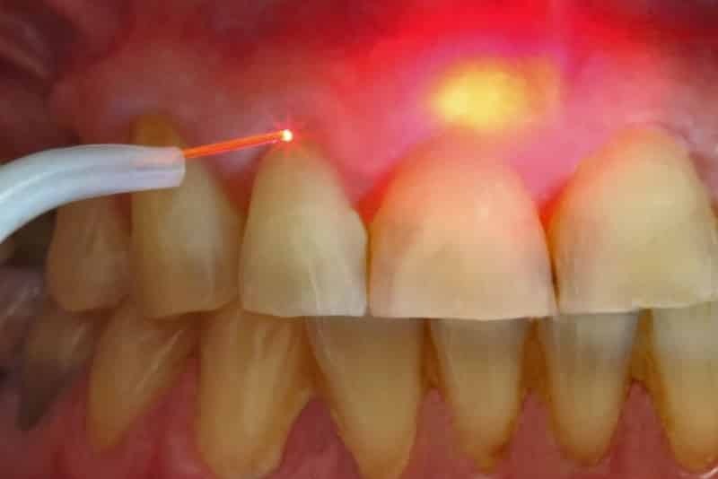 Removal of the laser cyst of the tooth