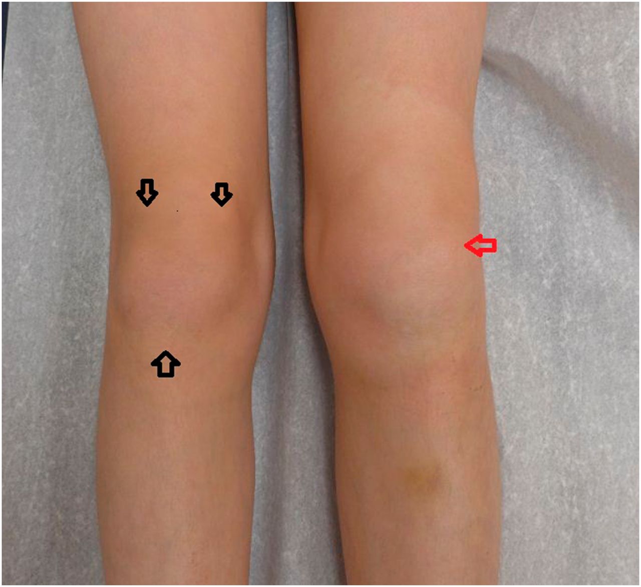 Juveniilne idiopaatiline artriit (JIA) lastel: sümptomid, ravi