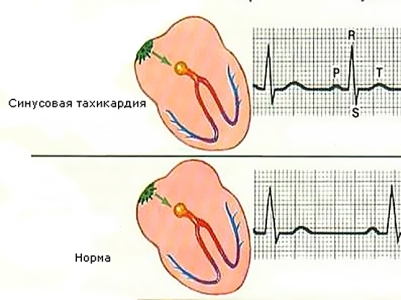 Sinus tachycardia