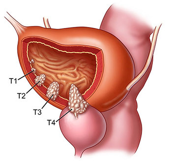 Symptoms and treatment of bladder cancer in men