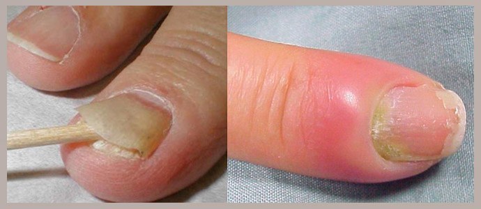 Erweichung der Nagelplatte, Beseitigung von Hyperämie