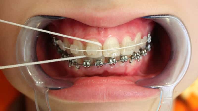 wie für Zahnspangen Pflege