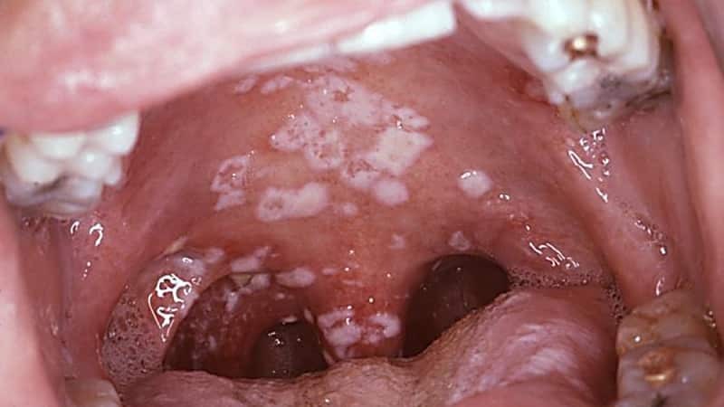 From what causes stomatitis causes treatment