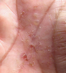 Atopisches( allergisches) Ekzem an den Händen