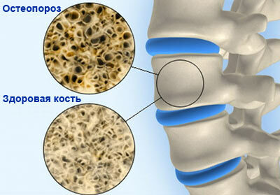osteoporoza