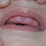 Beklim de eerste tanden van het kind