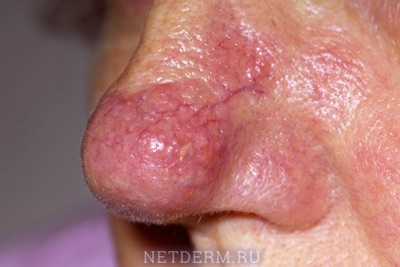 La fase fimatoide de la rosácea en la cara