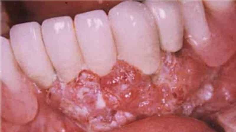 cancer i tandköttet inledande skede foto