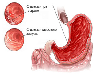 Mucus-associated gastritis