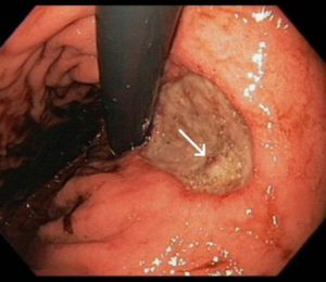 Gastrointestinálny vred