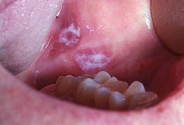 Mundkrebs Symptome in den Mund Fotofunktionen