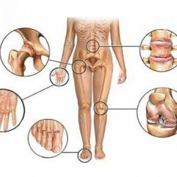 Types of joint arthrosis
