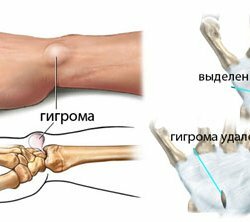 Traditional treatment of hygroma