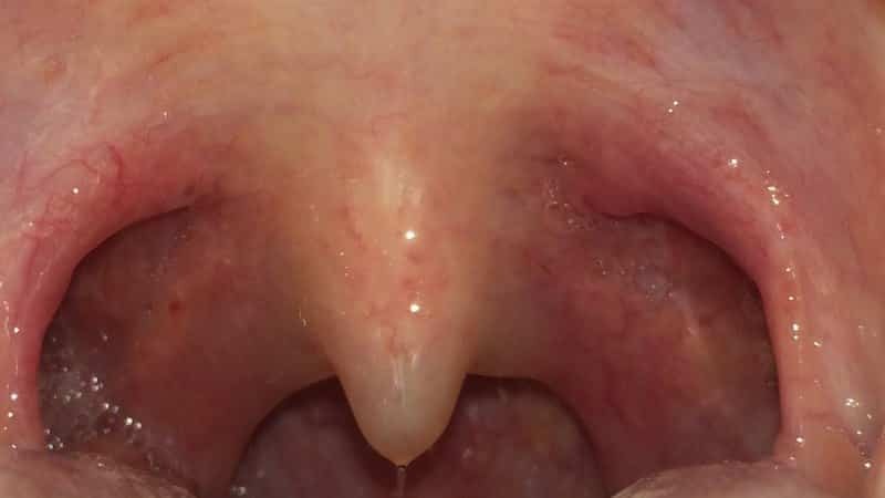 Removal of tonsillitis in tonsillitis