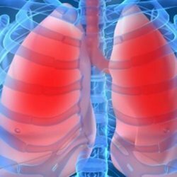 A tüdő sarcoidózisa: szakaszok, tünetek, kezelés