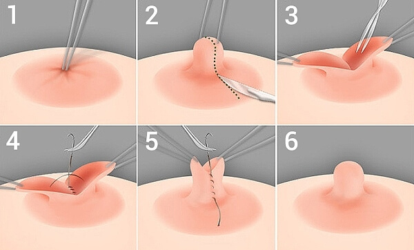 Retracted nipples: correction and possible problems