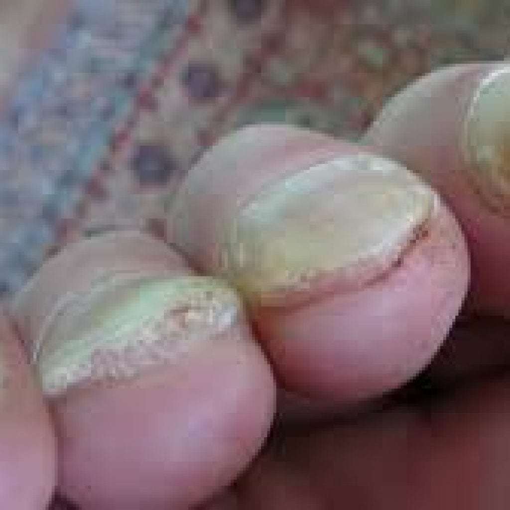 Diseases of the nails on the hands and feet: photo and description