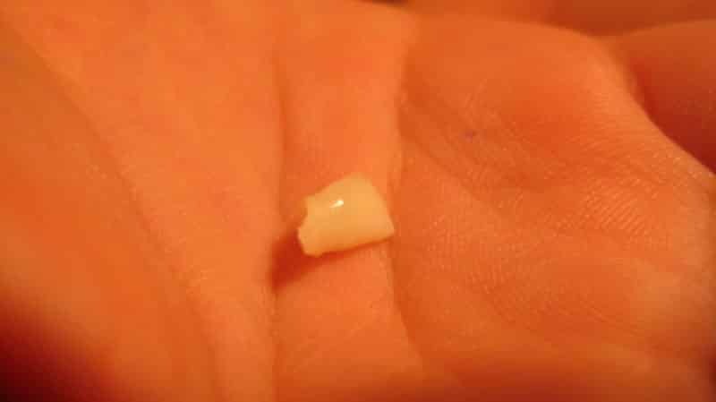 Mliečnych zubov u detí: strata režimu časovanie, fotky